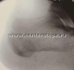 Haglund-shinz deformare (gaglunda, pompa-bump), boala nordica, osteochondropatia de keller ii,