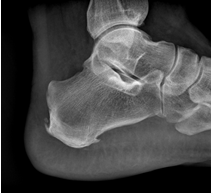 Haglund-shinz deformare (gaglunda, pompa-bump), boala nordica, osteochondropatia de keller ii,