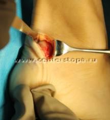 Haglund-shinz deformare (gaglunda, pompa-bump), boala nordica, osteochondropatia de keller ii,