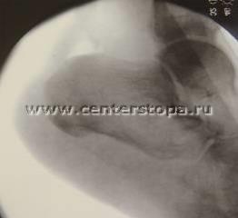 Haglund-shinz deformare (gaglunda, pompa-bump), boala nordica, osteochondropatia de keller ii,