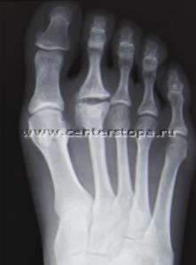 Haglund-shinz deformare (gaglunda, pompa-bump), boala nordica, osteochondropatia de keller ii,