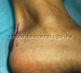 Haglund-shinz deformare (gaglunda, pompa-bump), boala nordica, osteochondropatia de keller ii,