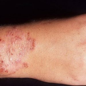 Simptomele dermatomicozelor la om și tratament, agenți patogeni ai dermatomicozei