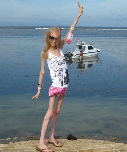 Diet győzelem felé fordult Xenia Bubenko szakaszában anorexia