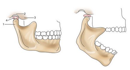 Disfuncția articulației temporomandibulare (vnchs)