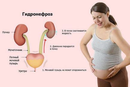 Kétoldalas hydronephrosist, vese- tünetei és kezelése