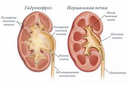 Hidronefroza bilaterală a simptomelor și tratamentului renal