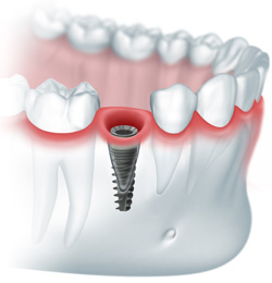 Implantarea Express, implantarea bazală, costul de implantare, sarcina imediată