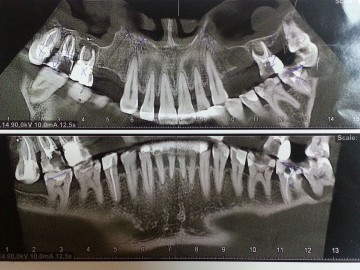 Implantarea Express, implantarea bazală, costul de implantare, sarcina imediată