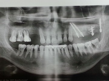 Implantarea Express, implantarea bazală, costul de implantare, sarcina imediată