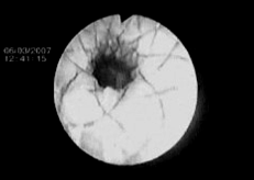 Endoscopic stenting al traheei - medicina practică - medicina practică