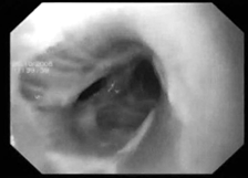 Endoszkópos stent beültetést a légcső - az orvosi gyakorlatban - az orvosi gyakorlat