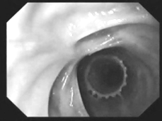 Endoscopic stenting al traheei - medicina practică - medicina practică