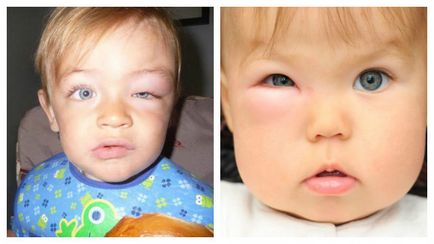 Якщо опух очей від укусу комара у дитини - рекомендації по лікуванню