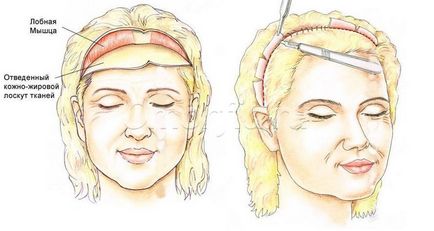 Front-lifting temporal - o modalitate eficientă de a strânge fruntea și sprâncenele - blog-ul proiectului omorfia