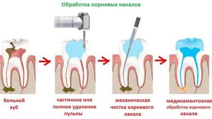 Глибокий карієс фото, симптоми, етапи лікування