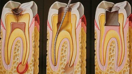Глибокий карієс фото, симптоми, етапи лікування