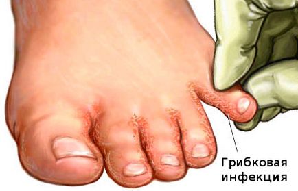Ciuperca pe picioarele unghiilor, pe picioare - tratament, remedii populare