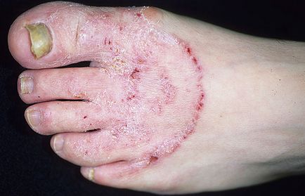 Ciuperca pe picioarele unghiilor, pe picioare - tratament, remedii populare