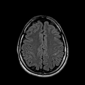 Infarctul creierului (infarct lacunar)