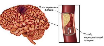 Accident vascular cerebral ischemic al simptomelor creierului, predicții, tratament, sănătatea capului