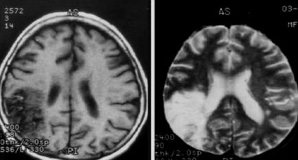 Accident vascular cerebral ischemic al simptomelor creierului, predicții, tratament, sănătatea capului