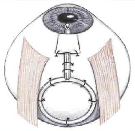 Drenuri artificiale de scurgere