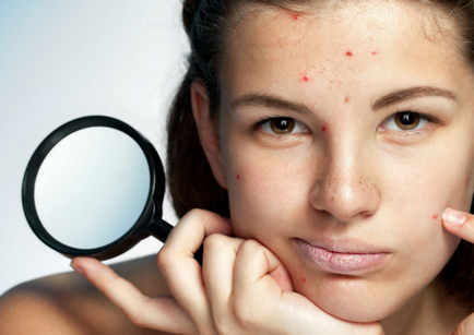 Iodul împotriva acneei este un mod eficient sau un pericol pentru piele