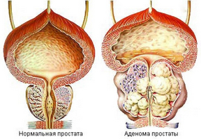 Ce ar trebui să fie dieta după îndepărtarea adenomului glandei prostate de fapt