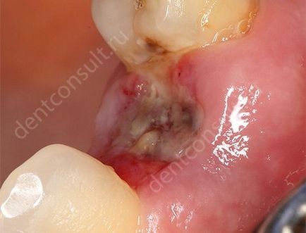 Care sunt complicațiile după extracția dinților?