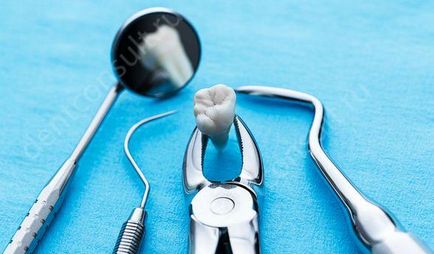 Care sunt complicațiile după extracția dinților?