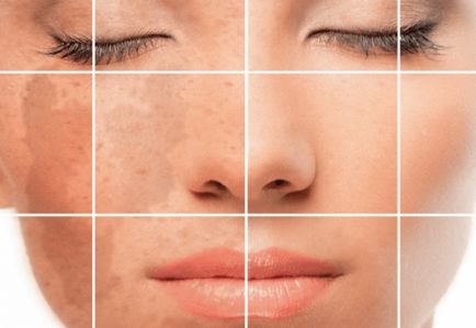 Ce proceduri cosmetice va proteja împotriva fotopolimerizării pielii?