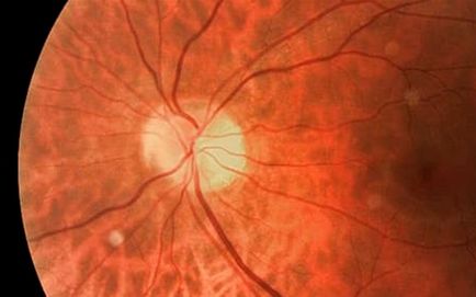 Cum se utilizează terapia pentru a restabili vederea