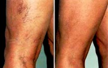Hogyan kerüljük el a rosacea (okok seprűvénák vagy rosacea) Hogyan kerüljük el a rosacea