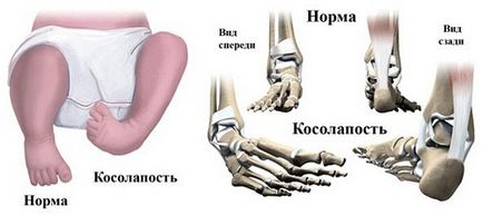 Як відучити дитину Косолапов, як відучити дитину