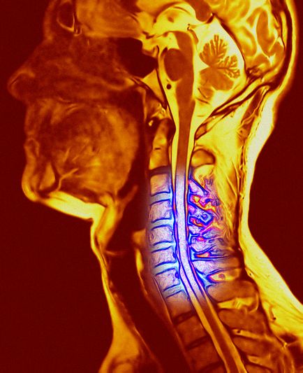 Cum afectează osteochondroza cervicală starea noastră de 7 rețete de medicină populară din cauza osteochondrozelor