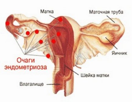 Cum să rămâneți însărcinată îndoind uterul