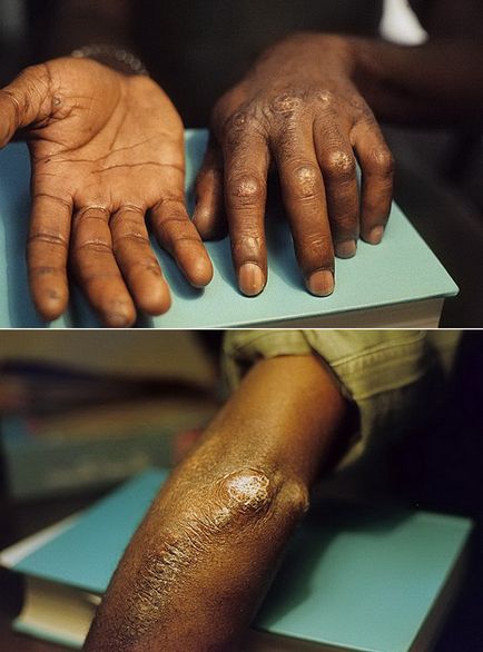 Кальциноз шкіри види і причини патології, прояви, принципи лікування
