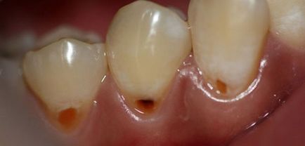 Карієс на зубах як його визначити і вилікувати