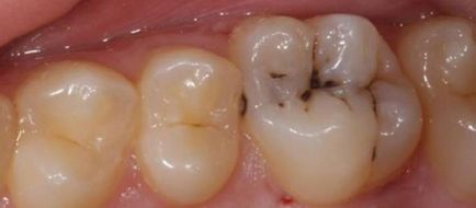 Caries pe dinți cum să identifice și să-l vindece