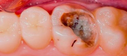 Caries pe dinți cum să identifice și să-l vindece