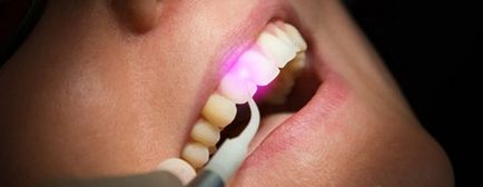 Üregek a fogak hogyan lehet azonosítani és kezelni