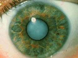 Катаракта, катаракта очі, видалення катаракти, катаракта симптоми, операція катаракта, лікування ката
