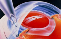 Cataracta cauzele, etapele, simptomele și tratamentul cataractei