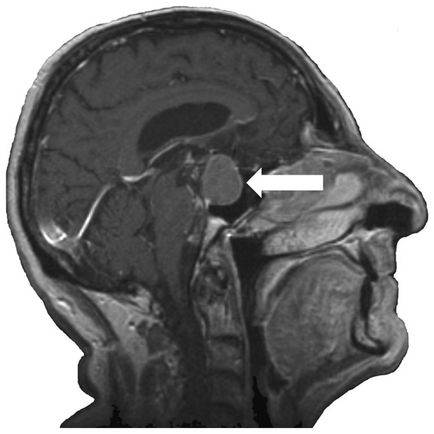 Chistul simptomelor, tratamentului și consecințelor glandei pituitare