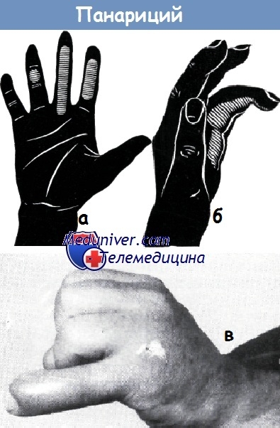 Clinica și diagnosticul de panaritiu (inflamarea purulentă a mâinii)