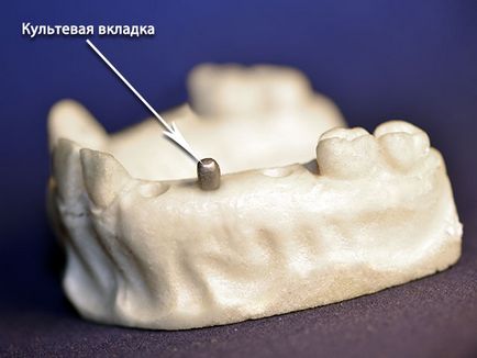 Sapkák (pulpitis) sapkák