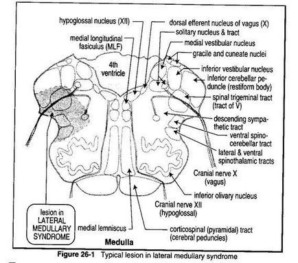 Лакунарні інсульти невеликі інфаркти в глибині гм (некорковие) або стовбура гм (табл