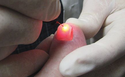 Лікування грибка нігтів перекисом водню