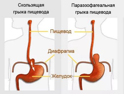 Лечение на рак на хранопровода операция херния без всички начини,